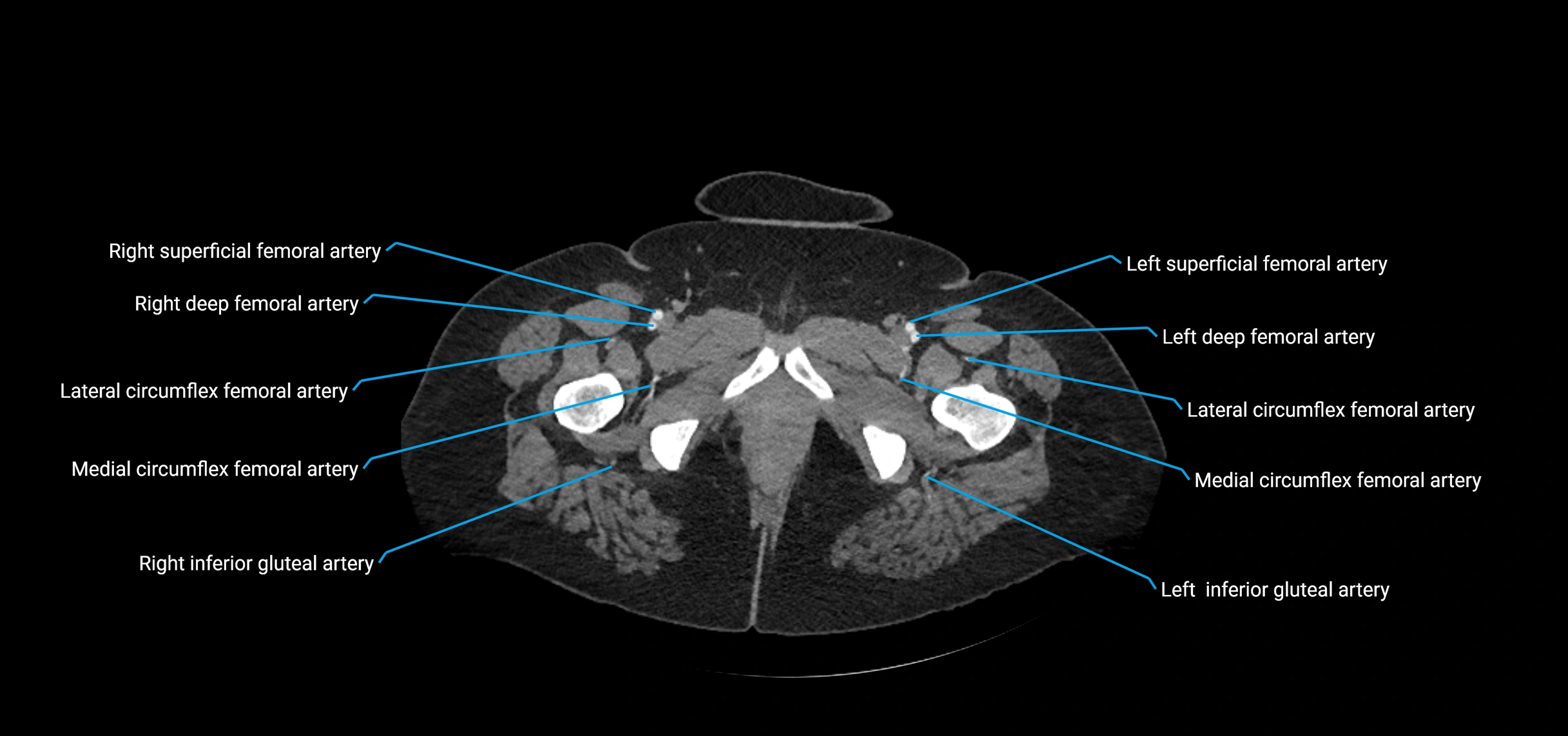 CTA abdomen axial cross sectional anatomy labelled image_274 (2).webp